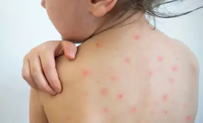 سُجِّلت في الجمهورية القرغيزية 8211 حالة إصابة بمرض الحصبة